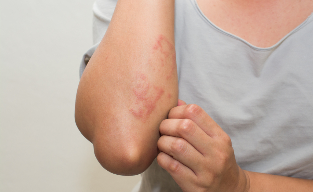 ডায়াবেটিসে ত্বকের সমস্যা | কোন লক্ষণগুলো দেখে সচেতন হবেন?