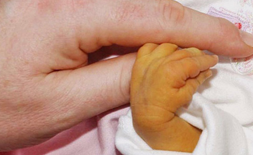 নবজাতকের জন্ডিস | প্রকারভেদ, কেন হয় ও করণীয় কী?