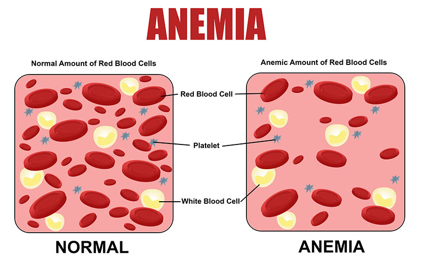 রক্তশূন্যতা বা Anemia-তে ভুগছেন না তো?