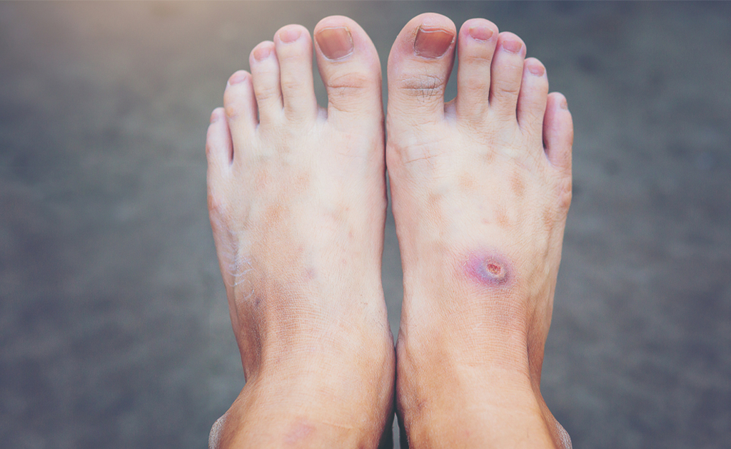 ডায়াবেটিক রোগীর পায়ের যত্ন কীভাবে নেওয়া উচিত?