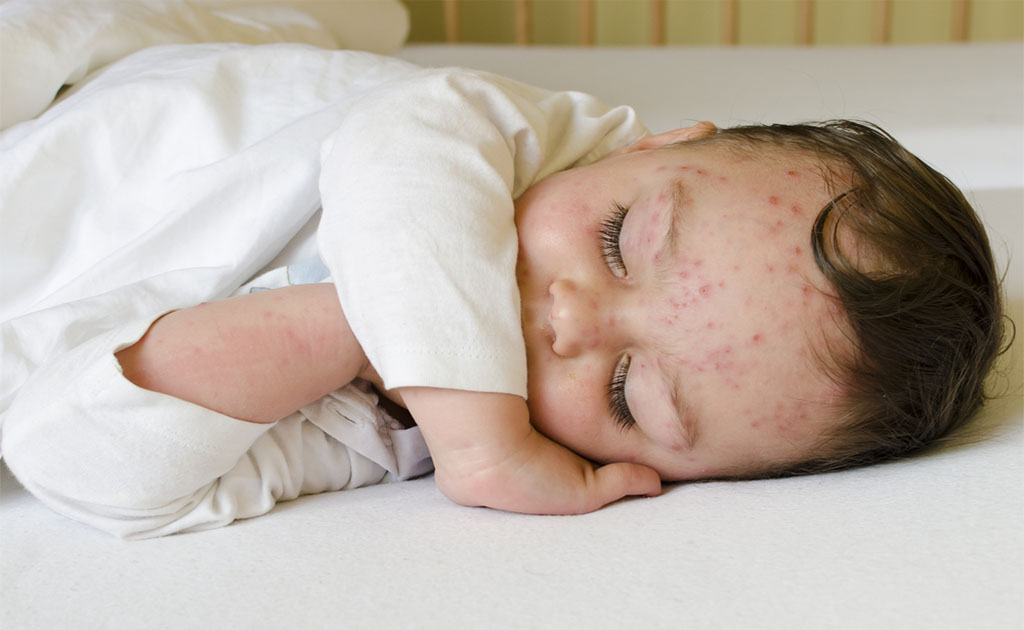 বসন্তকালে কোন রোগবালাই এ আক্রান্ত হওয়ার ঝুঁকি বেড়ে যায়?