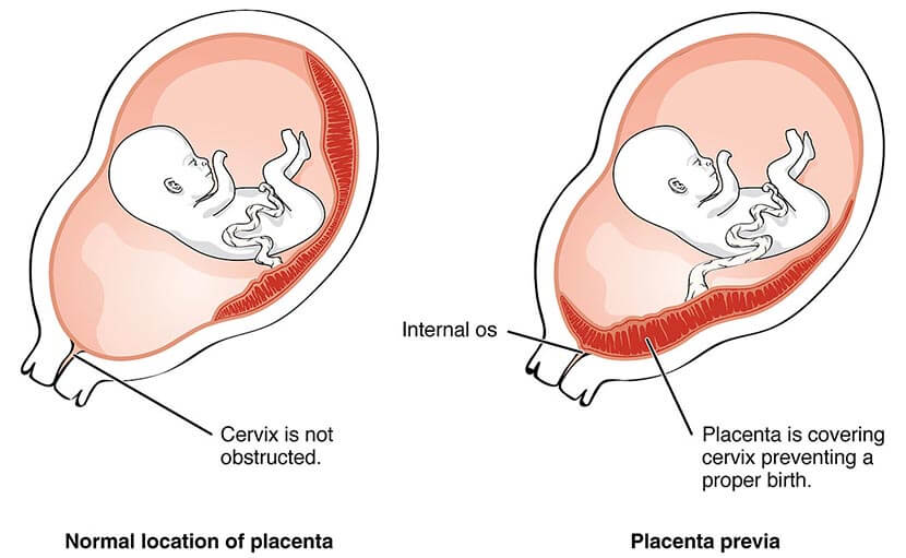 গর্ভাবস্থায় প্লাসেন্টা প্রিভিয়া | গর্ভফুল জরায়ু মুখে লেগে থাকলে করণীয় কী?