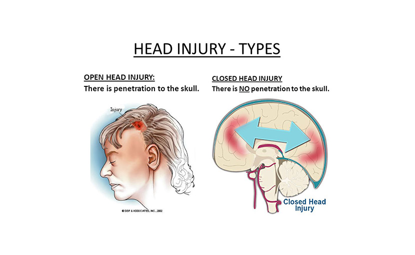 হেড ইনজুরি | মাথায় আঘাত লাগলে করণীয় কী?