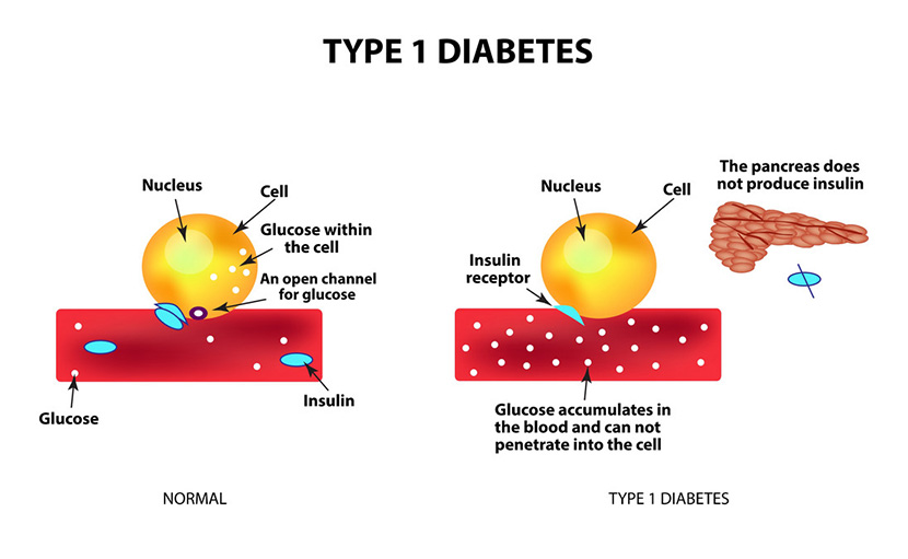 ডায়াবেটিস বা বহুমূত্র রোগ | টাইপ লক্ষণ কারণ প্রতিরোধ ও চিকিৎসা কী?
