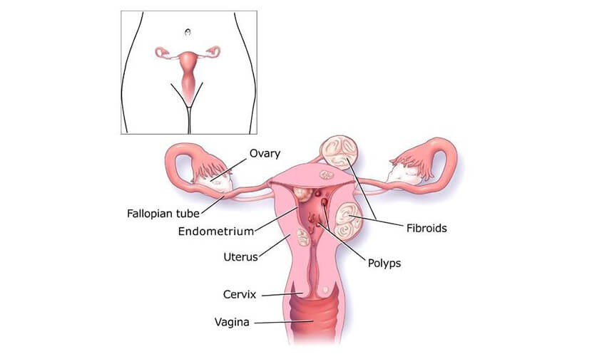 দীর্ঘ মেয়াদী পিরিয়ড (মেনোরেজিয়া) | কী ও কেন?